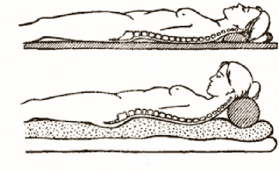 Figura di osteocondrosi