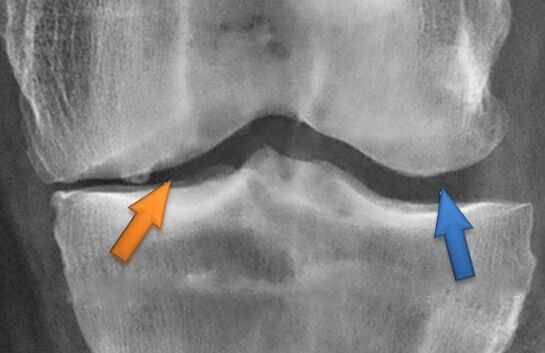 Kinesitherapy per l'artrosi